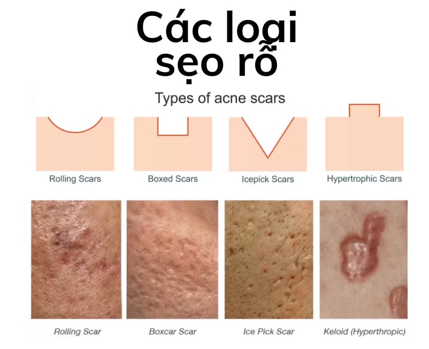 cac loai seo dieu tri