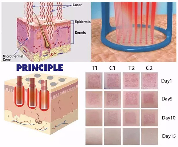dieu tri seo ro bang laser fractional
