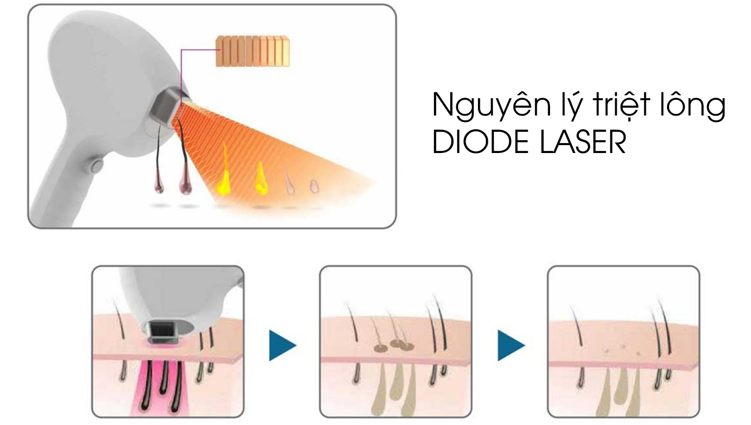triet long diode laser