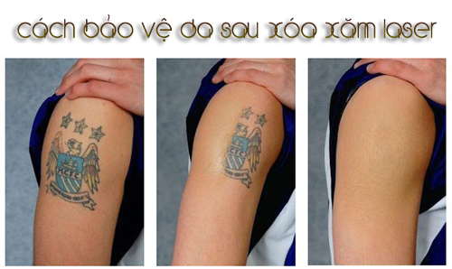 xoa xam laser