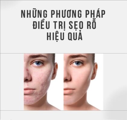Nhung-phuong-phap-dieu-tri-Seo-ro-hieu-qua