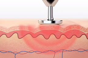 MÁY PLASMA THẨM MỸ BEAUTY MONSTER - Ảnh 8