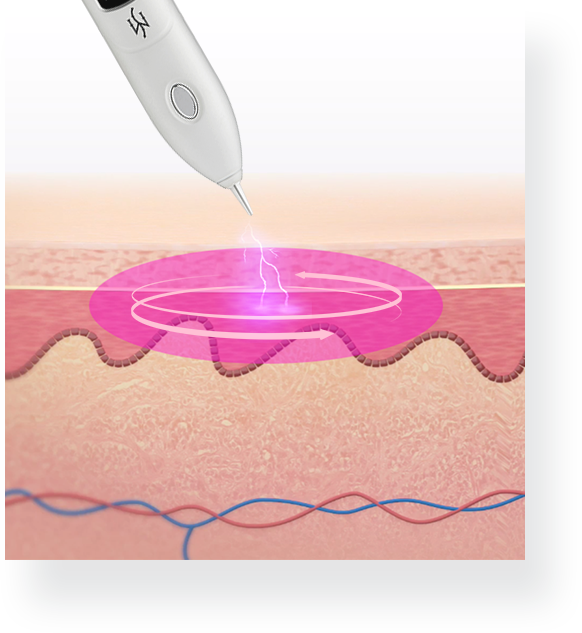 Máy plasma điều trị da Monster Gzel