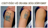 CÁCH GIÚP BẢO VỆ DA SAU KHI XÓA XĂM LASER